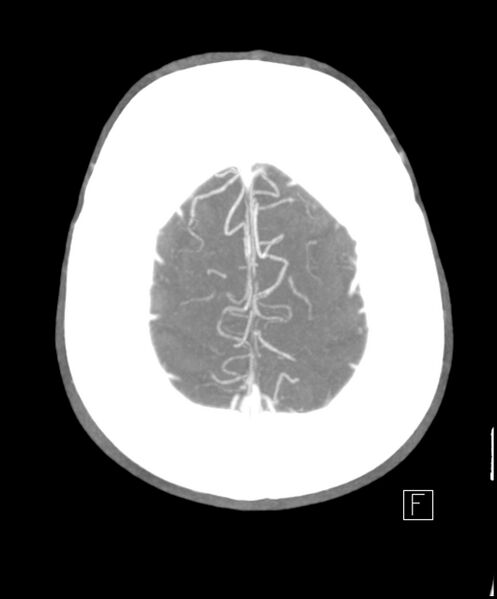 File:Acute P1 occlusion with PCA ischemia penumbra (CT perfusion) (Radiopaedia 72084-82587 Axial C+ arterial thick MIP 2).jpg