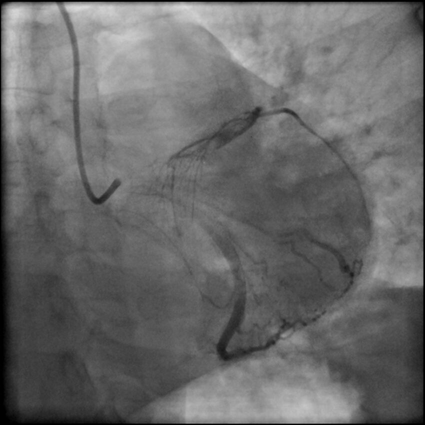 Acute anteroseptal myocardial infarction (Radiopaedia 68409-77946 LAO caudal (spider view) LAD and CX 52).jpg