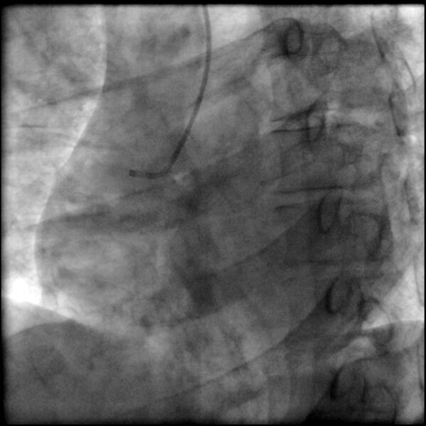File:Acute anteroseptal myocardial infarction (Radiopaedia 68409-77946 RAO straight RCA 3).jpg