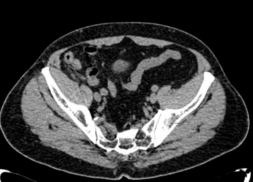 Acute appendicitis (Radiopaedia 13030-13091 Axial non-contrast 65).jpg