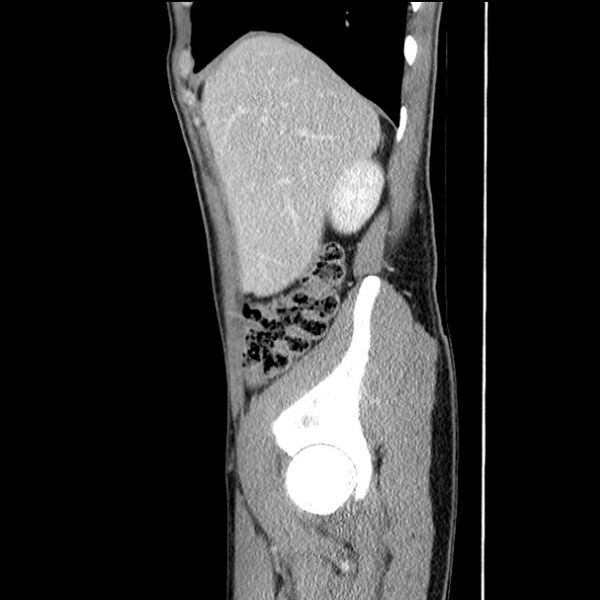 File:Acute appendicitis (Radiopaedia 27049-27227 Sagittal C+ portal venous phase 16).jpg