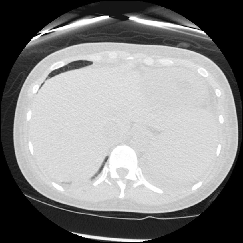 Acute lupus nephritis (Radiopaedia 45832-50107 Axial lung window 86).jpg