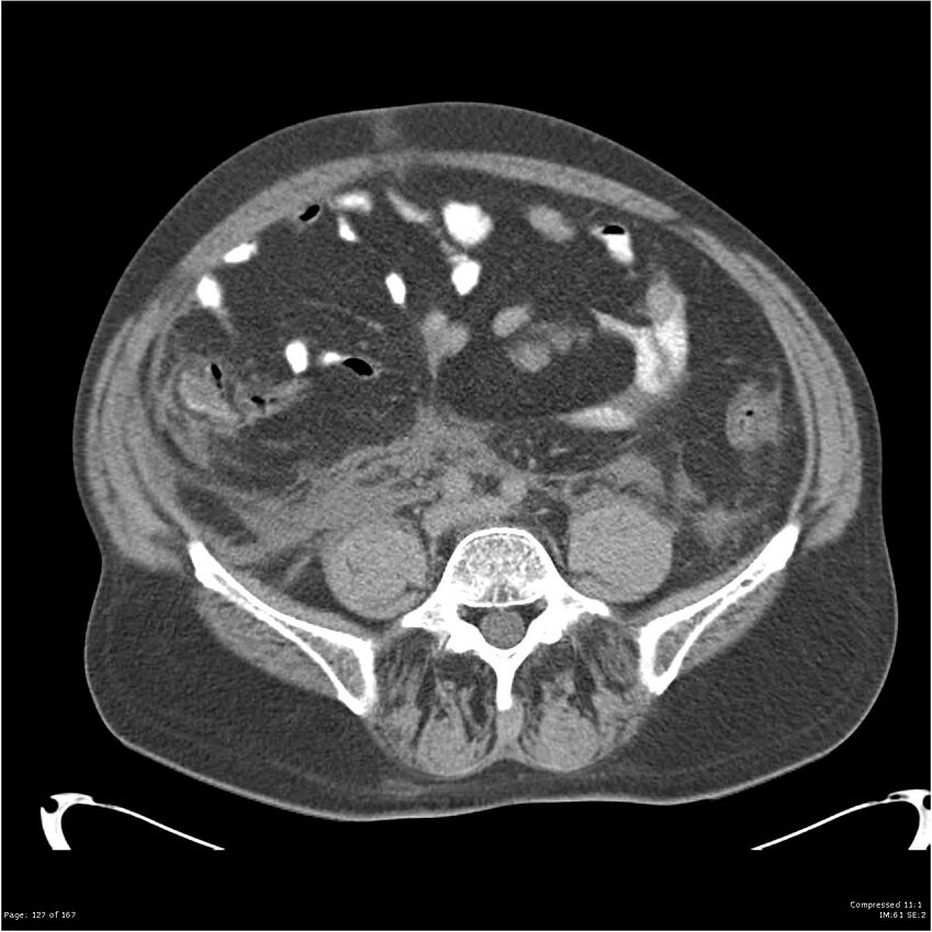 Acute pancreatitis (Radiopaedia 19135-19116 Axial non-contrast 41).jpg