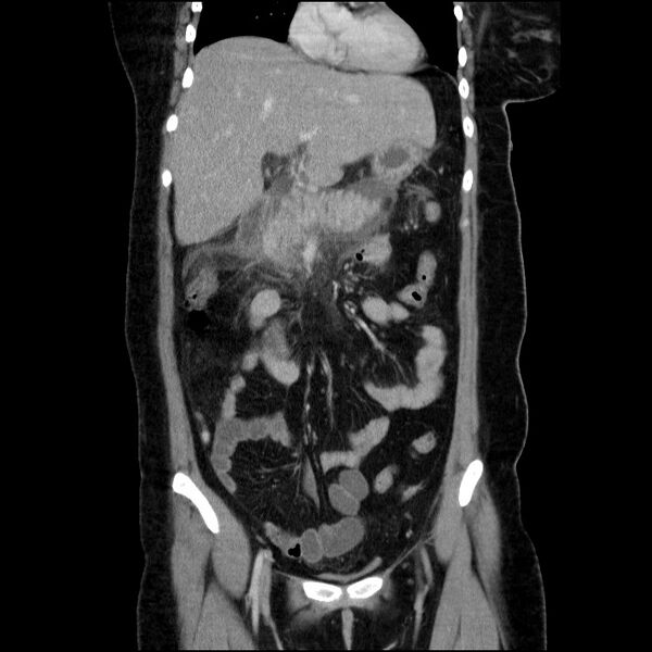 File:Acute pancreatitis (Radiopaedia 69236-79012 Coronal C+ portal venous phase 47).jpg