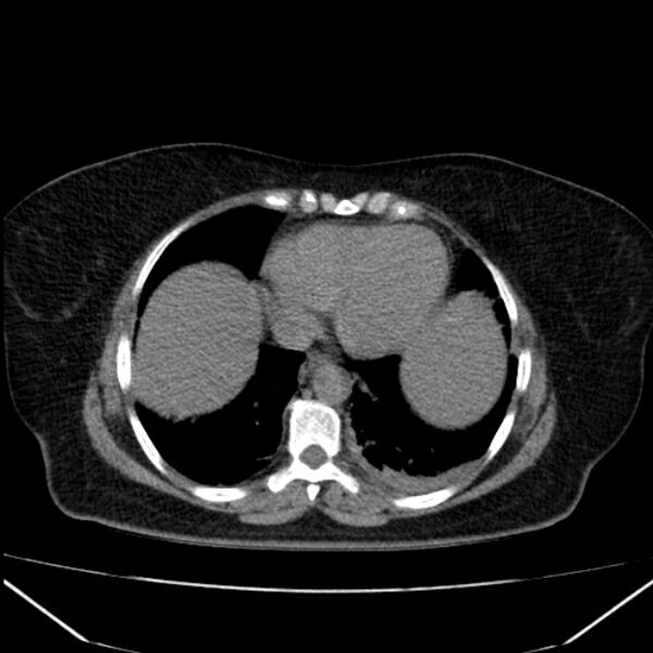 File:Acute pancreatitis - Balthazar C (Radiopaedia 26569-26714 Axial non-contrast 12).jpg