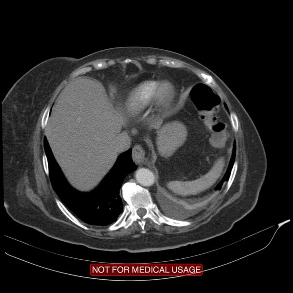 File:Acute pancreatitis with infected necrosis (Radiopaedia 26454-26585 Axial C+ arterial phase 1).jpg