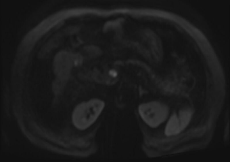 File:Acute portal vein thrombosis (Radiopaedia 73198-83925 Axial DWI 76).jpg
