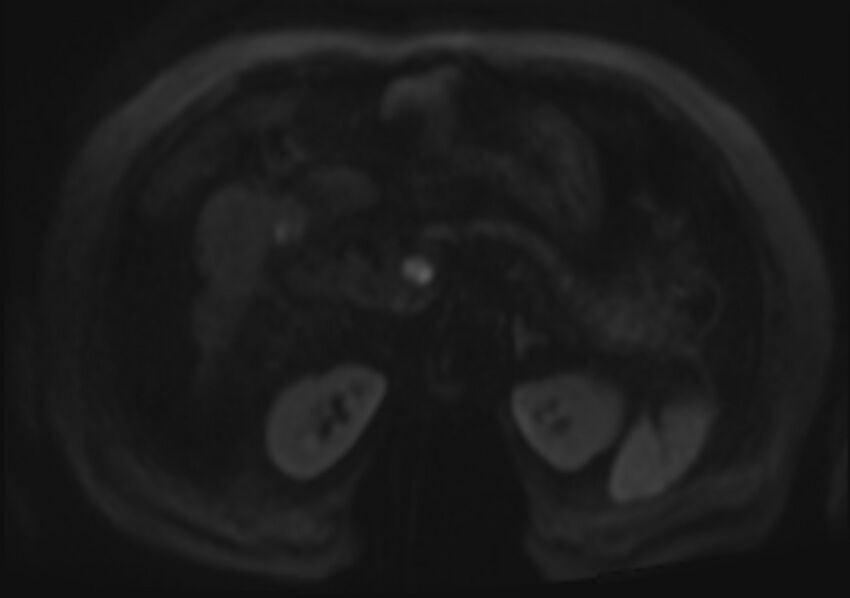 Acute portal vein thrombosis (Radiopaedia 73198-83925 Axial DWI 76).jpg