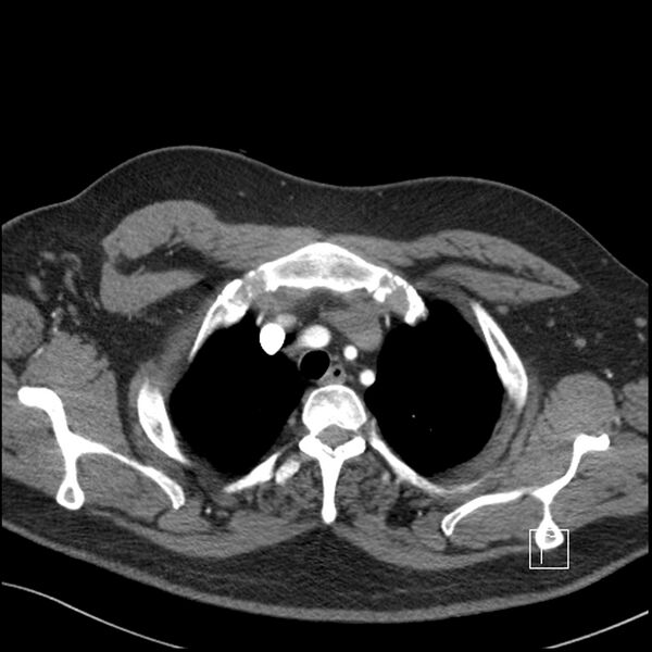 File:Acute pulmonary embolism with pulmonary infarct (Radiopaedia 73062-83768 Axial C+ CTPA 9).jpg