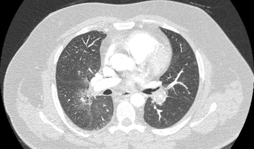 Acute pulmonary embolism with pulmonary infarcts (Radiopaedia 77688-89908 Axial lung window 54).jpg