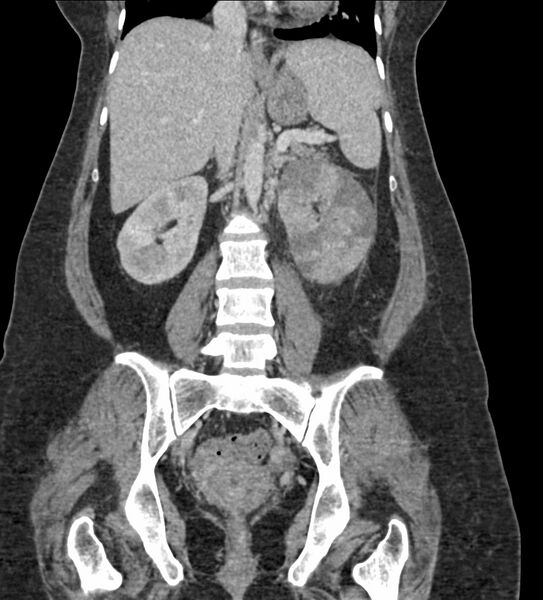 File:Acute pyelonephritis with renal vein thrombosis (Radiopaedia 58020-65053 Coronal renal parenchymal phase 60).jpg