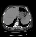 Acute renal failure post IV contrast injection- CT findings (Radiopaedia 47815-52559 Axial C+ portal venous phase 14).jpg