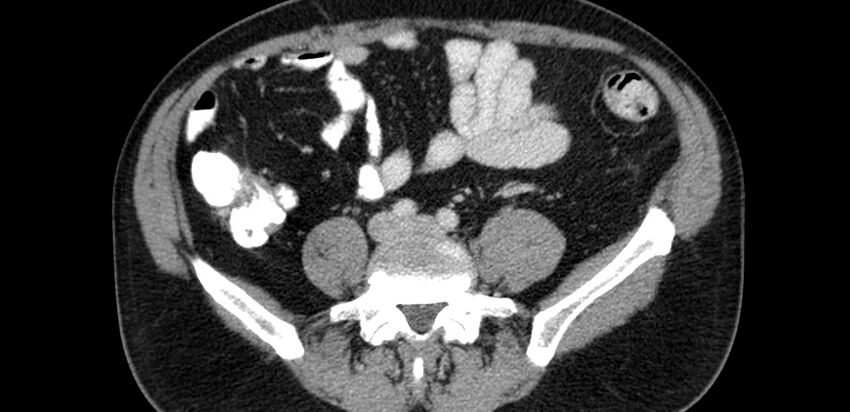 Acute sigmoid colon diverticulitis (Radiopaedia 55507-61976 Axial C+ portal venous phase 53).jpg