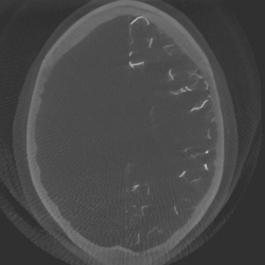 Acute subarachnoid hemorrhage and accessory anterior cerebral artery (Radiopaedia 69231-79010 C 49).jpg