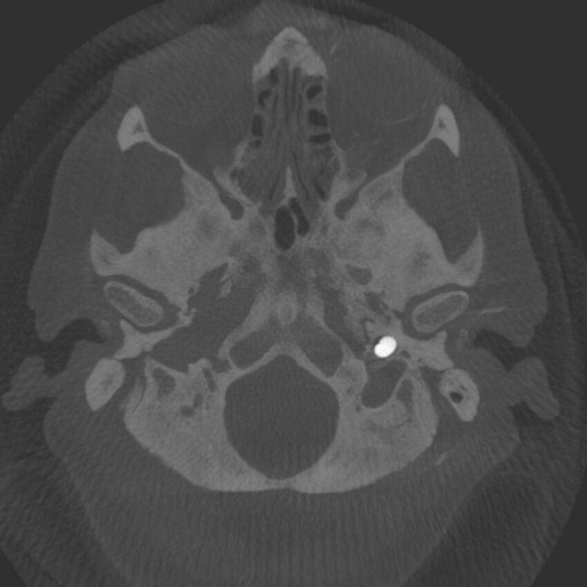 Acute subarachnoid hemorrhage and accessory anterior cerebral artery (Radiopaedia 69231-79010 C 5).jpg