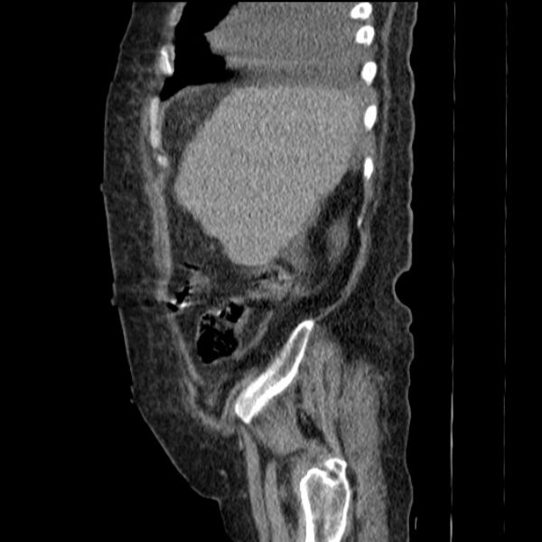 File:Acute tubular necrosis (Radiopaedia 28077-28334 H 19).jpg
