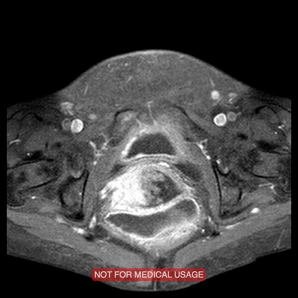 File:Adenocarcinoma of the cervix (Radiopaedia 28373-28615 Axial T1 C+ fat sat 5).jpg