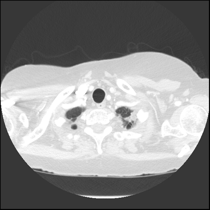 Adenocarcinoma of the lung (Radiopaedia 41015-43755 Axial lung window 9).jpg