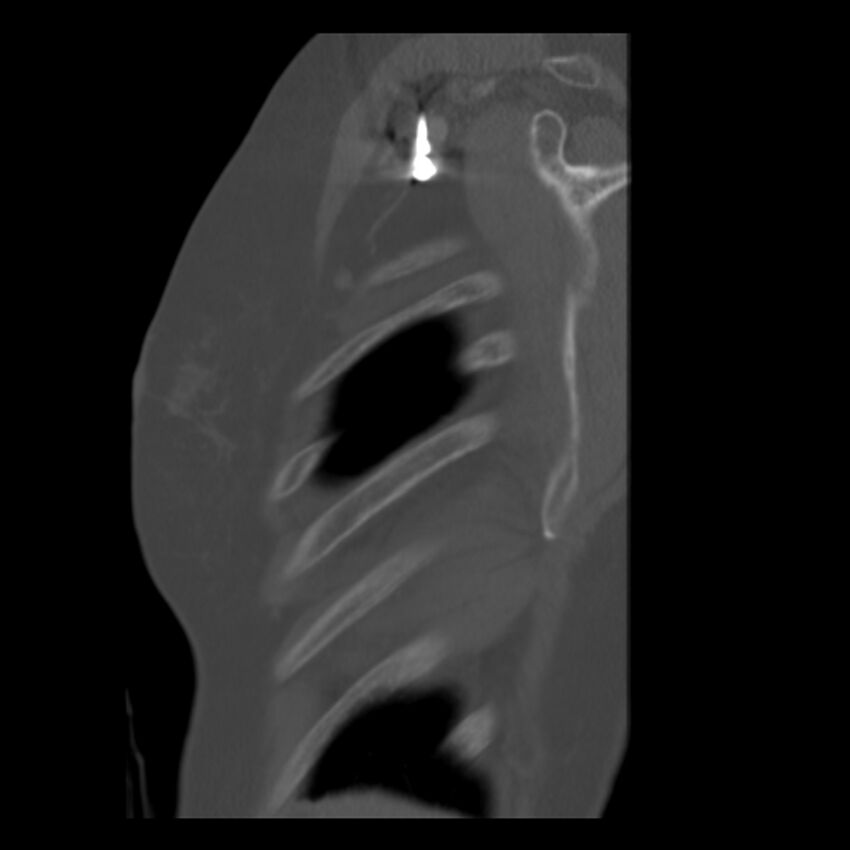 Adenocarcinoma of the lung (Radiopaedia 41015-43755 Sagittal bone window 4).jpg