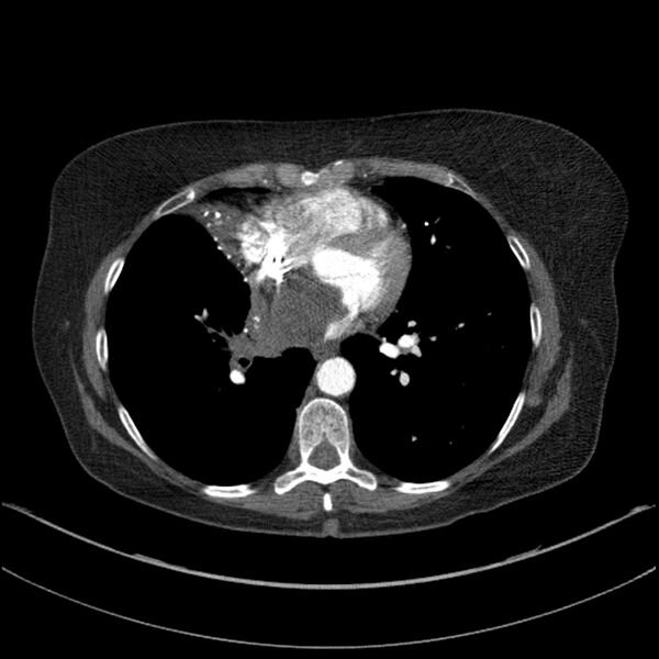 File:Adenocarcinoma of the lung (Radiopaedia 44205-47803 Axial C+ portal venous phase 53).jpg