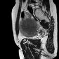 Adenomyoma of the uterus (huge) (Radiopaedia 9870-10438 Sagittal T2 2).jpg