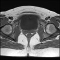 Adenomyosis - ovarian endometriomas (Radiopaedia 67031-76350 Axial T1 22).jpg