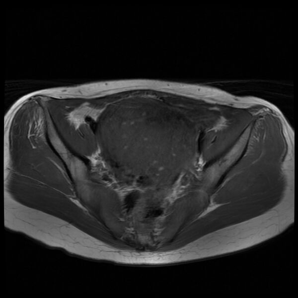 File:Adenomyosis on MRI (Radiopaedia 29328-29780 Axial T1 3).jpg