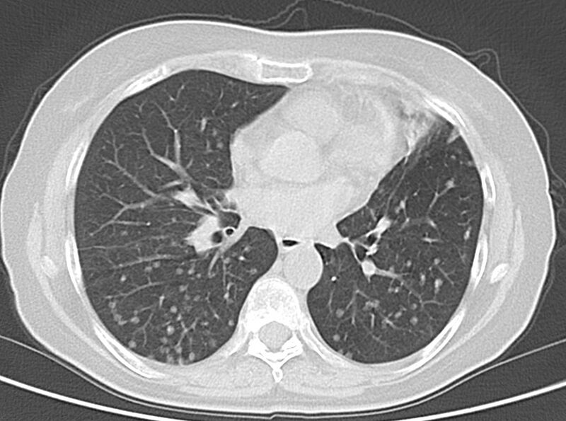 File:Adenosquamous lung carcinoma (Radiopaedia 22035-22030 lung window 35).jpg