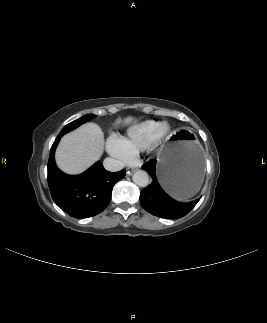 Adhesional small bowel obstruction (Radiopaedia 85402-101024 Axial C+ portal venous phase 26).jpg