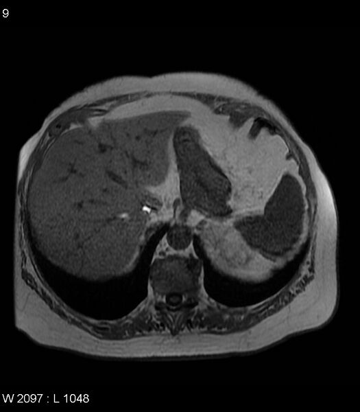 File:Adrenal myelolipoma (Radiopaedia 6765-7961 Axial T1 in-phase 9).jpg