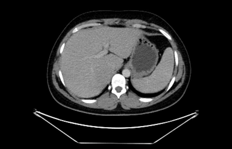 File:Adrenocortical carcinoma (Radiopaedia 80134-93438 Axial C+ portal venous phase 27).jpg