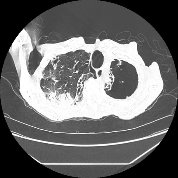 File:Advanced pulmonary tuberculosis (Radiopaedia 8599-9431 Axial lung window 9).jpg