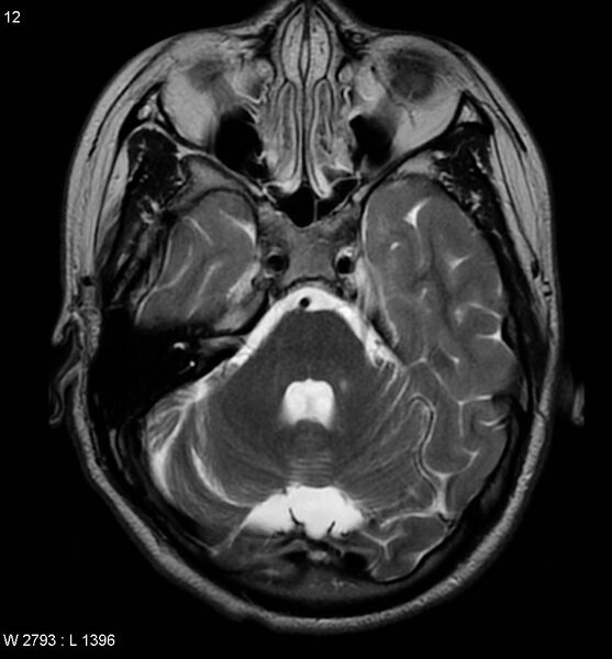 File:Aicardi syndrome (Radiopaedia 5353-7117 Axial T2 7).jpg