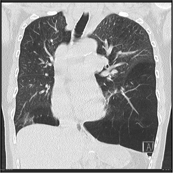 File:Alpha-1-antitrypsin deficiency (Radiopaedia 26537-26678 Coronal lung window 15).jpg