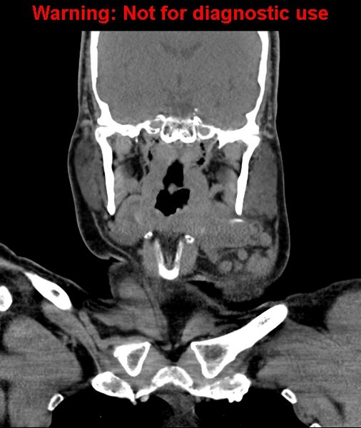 File:Ameloblastoma (Radiopaedia 33126-34164 D 39).jpg