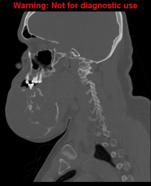 File:Ameloblastoma (Radiopaedia 33126-34164 Sagittal bone window 33).jpg