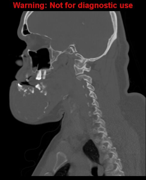 File:Ameloblastoma (Radiopaedia 33126-34164 Sagittal bone window 47).jpg