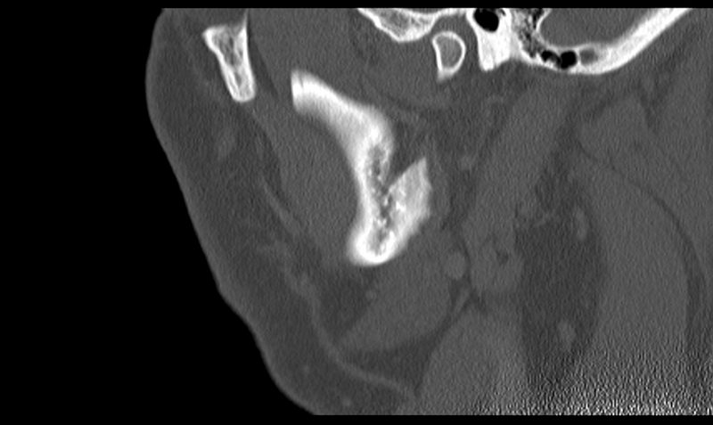 File:Ameloblastoma (Radiopaedia 33677-34806 Sagittal bone window 48).png