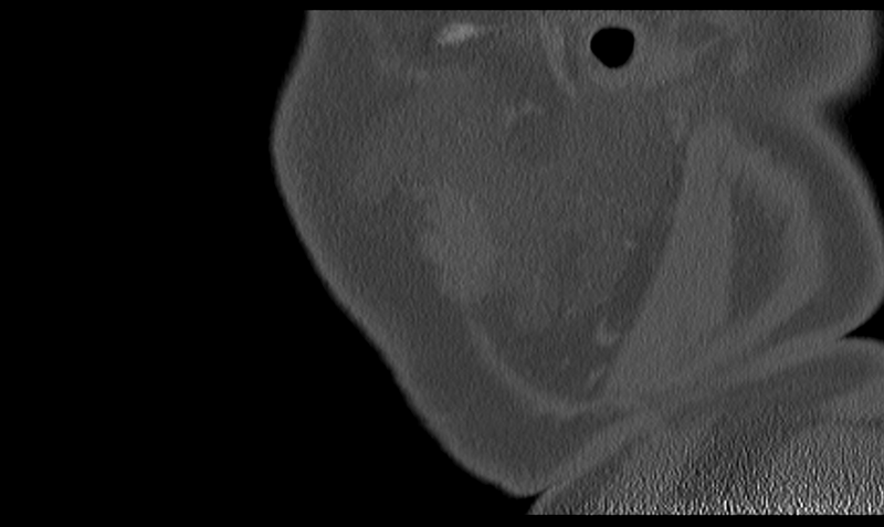 File:Ameloblastoma (Radiopaedia 33677-34806 Sagittal bone window 56).png