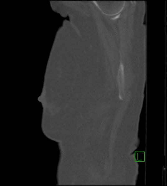 File:Amiodarone deposition in the liver (Radiopaedia 77587-89780 Sagittal bone window 92).jpg
