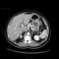 Ampullary carcinoma (Radiopaedia 56396-63056 B 23).jpg