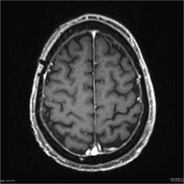 File:Anaplastic meningioma with recurrence (Radiopaedia 34452-35788 Axial T1 C+ 119).jpg