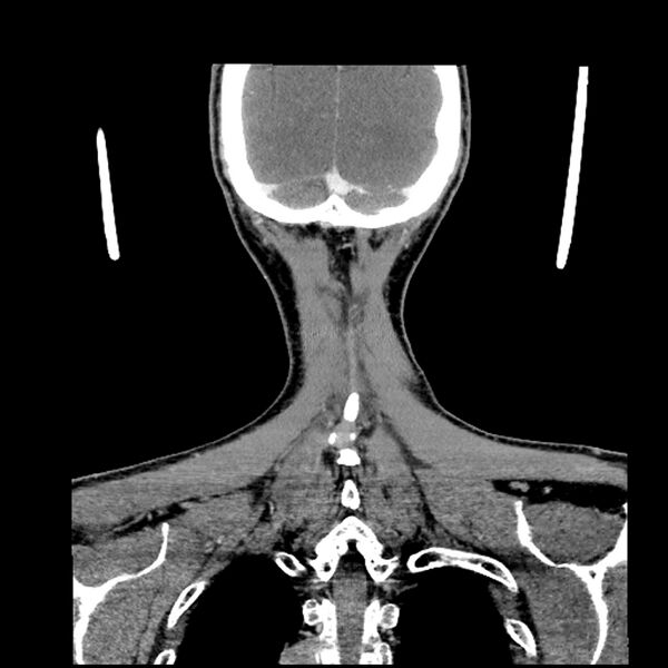 File:Anaplastic thyroid carcinoma (Radiopaedia 79087-92034 A 102).jpg