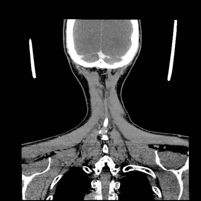 Anaplastic thyroid carcinoma (Radiopaedia 79087-92034 A 102).jpg