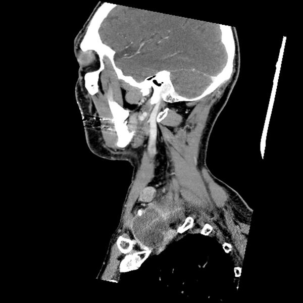 File:Anaplastic thyroid carcinoma (Radiopaedia 79087-92034 C 26).jpg