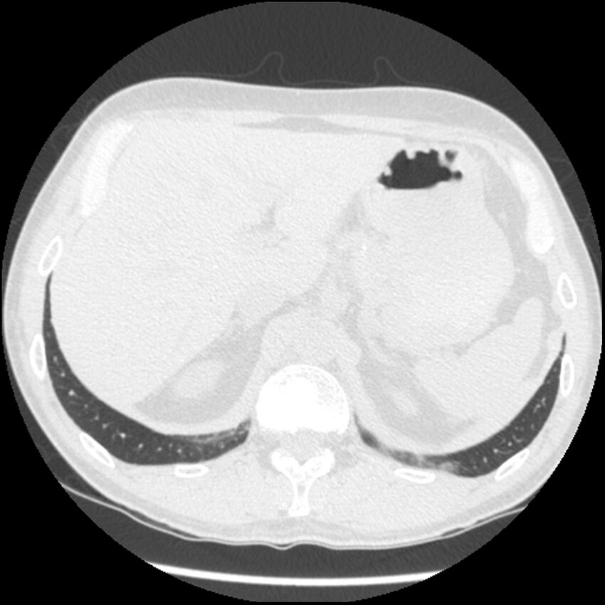 Angioinvasive aspergillosis (Radiopaedia 43957-47466 Axial lung window 66).jpg