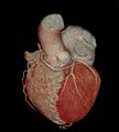 Anomalous left coronary artery- prepulmonic course (Radiopaedia 29253-29667 3D VRT 3).JPG