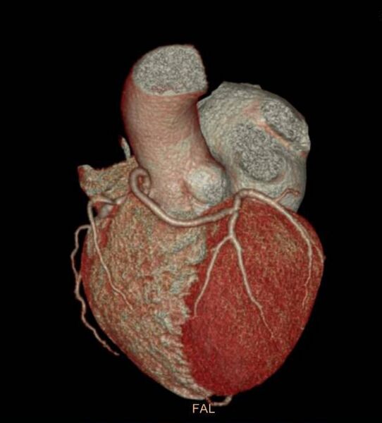 File:Anomalous left coronary artery- prepulmonic course (Radiopaedia 29253-29667 3D VRT 3).JPG