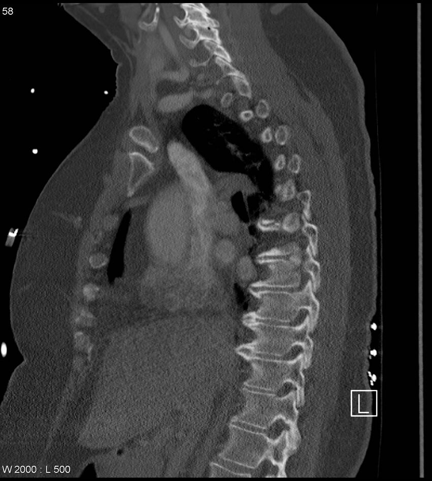 Anterior shoulder dislocation (CT) (Radiopaedia 59032-66309 Sagittal bone window 29).jpg