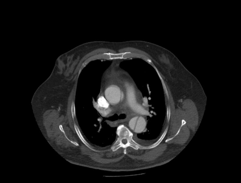 File:Aortic dissection (Radiopaedia 28802-29105 A 13).jpg